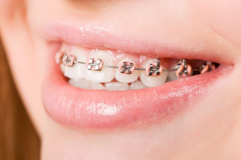 Ortodoncja - aparat stały na zębach