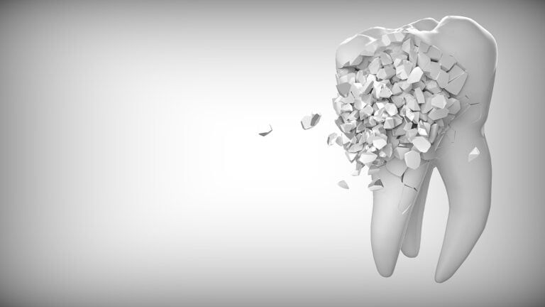 Próchnica zębów — co powinieneś wiedzieć o próchnicy