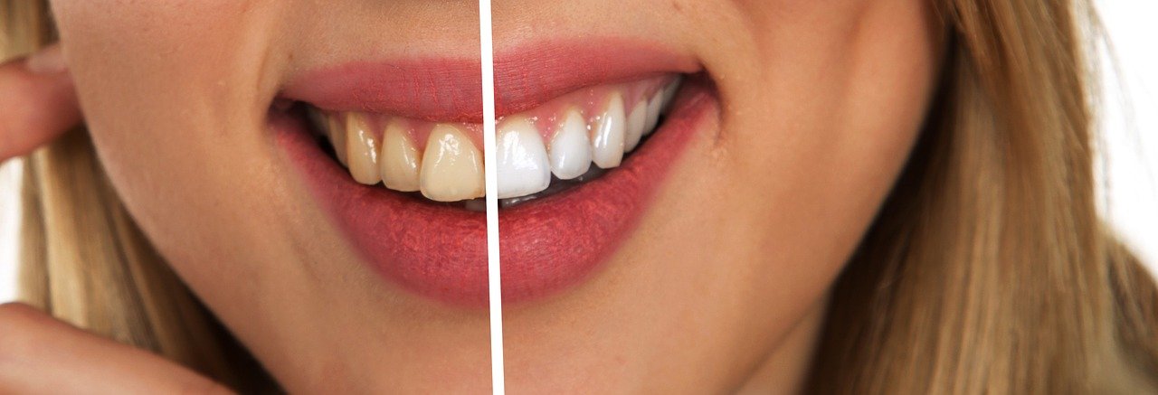 wybielanie zębów - porównanie przed i po